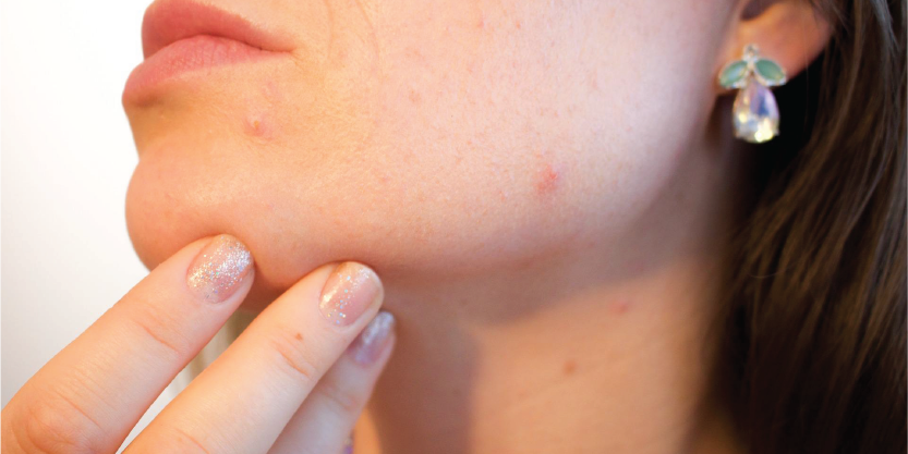 Pimples and Breakouts