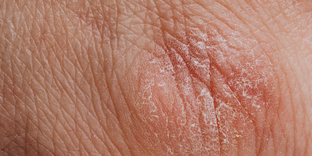 Eczema